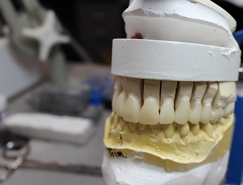 10 e-max crns and veneers 005.jpg